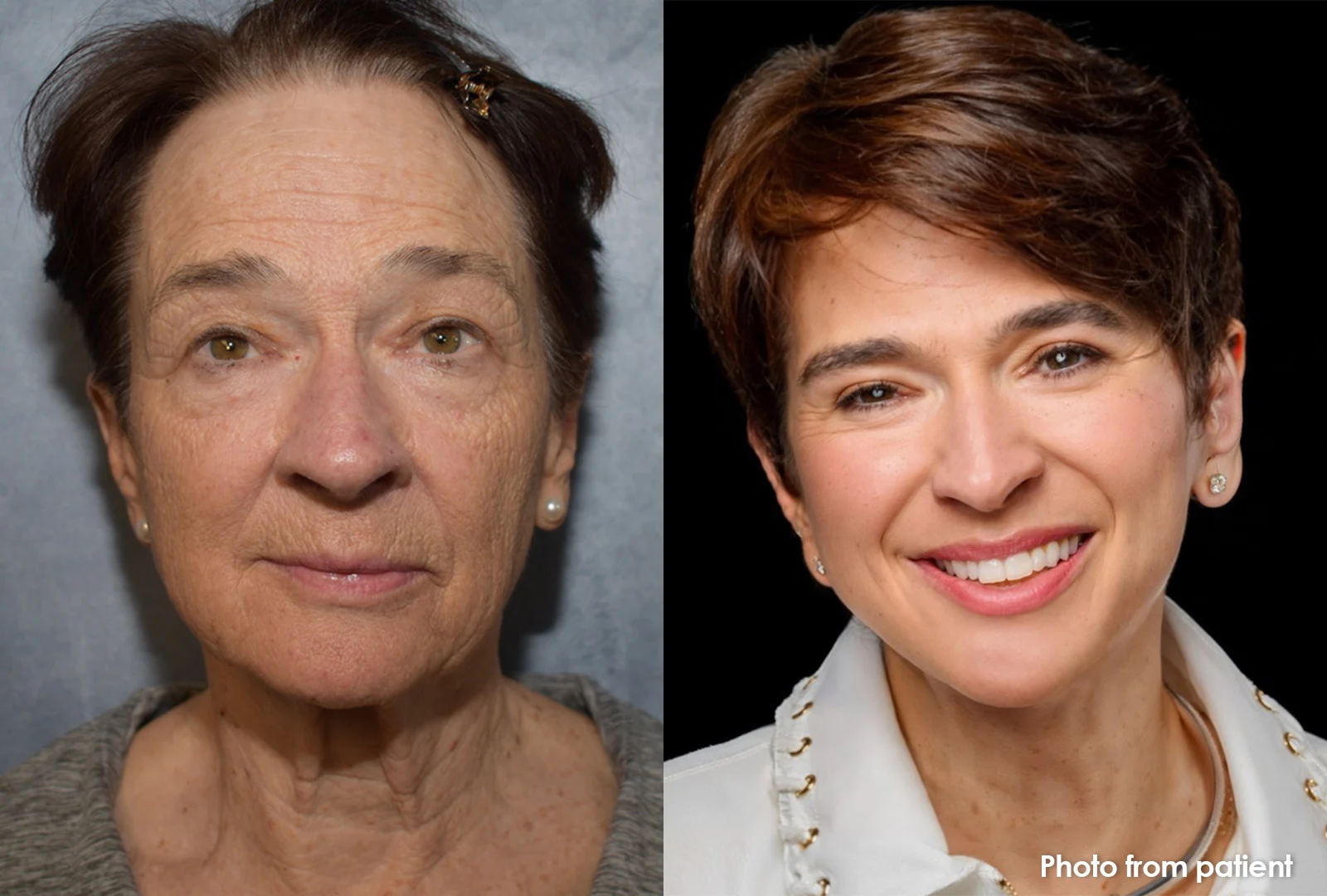 facelift before and after photo
